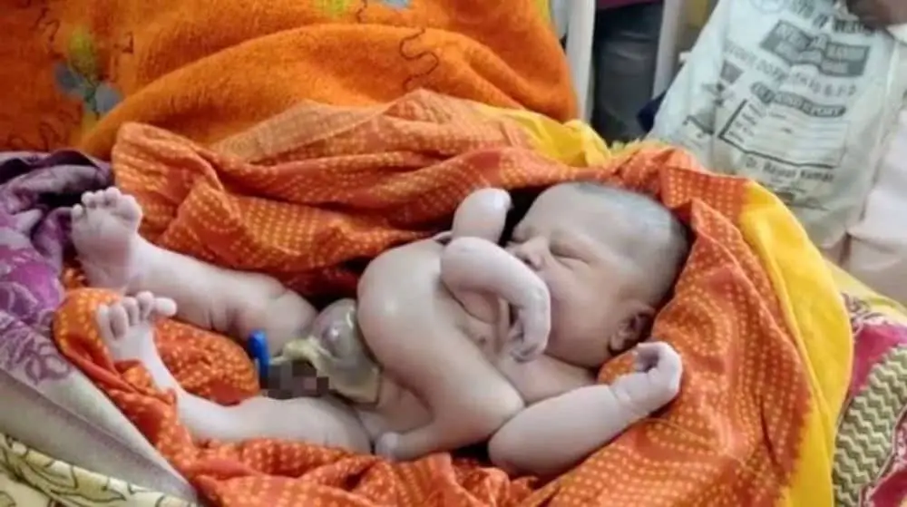 En Inde, un bébé est né avec une paire de bras et de jambes supplémentaires