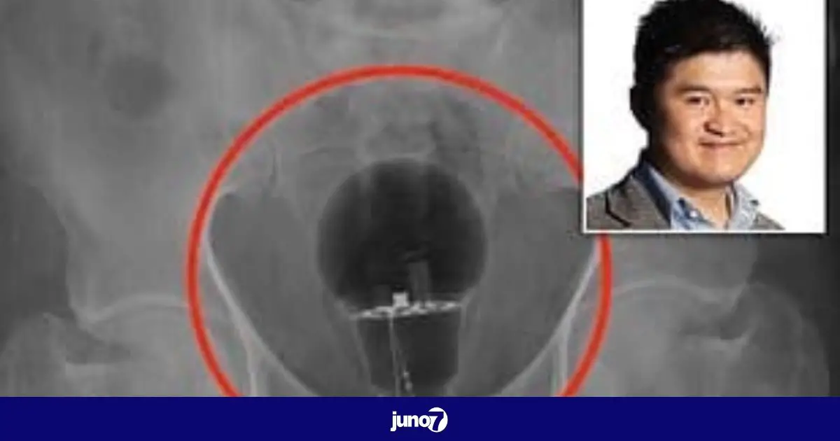 Colombie: des médecins ont trouvé une ampoule coincée dans l'anus d'un patient de 53 ans